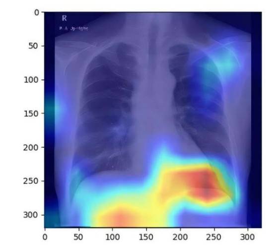 心脏和肺部的X光片也能捕捉到部分肝脏图像,从而让深度学习模型能够检测脂肪肝疾病