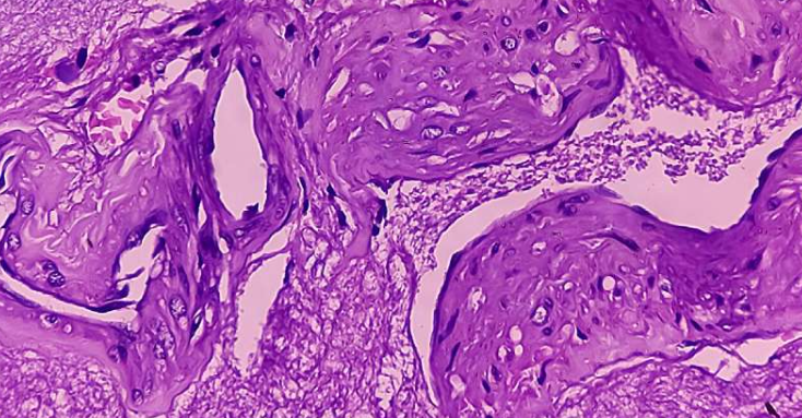 3D打印肾脏肿瘤展现出更有针对性的治疗潜力