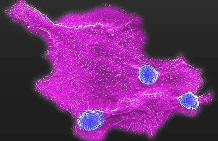 显微镜图像显示，造血干细胞工程化的CAR-NKT细胞(蓝色)正在攻击人类实体瘤细胞(洋红色)。
